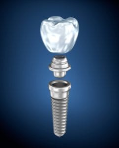 Dental Implants in Middle River, Maryland