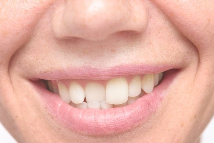 Crooked teeth treatment in Middle River, Maryland