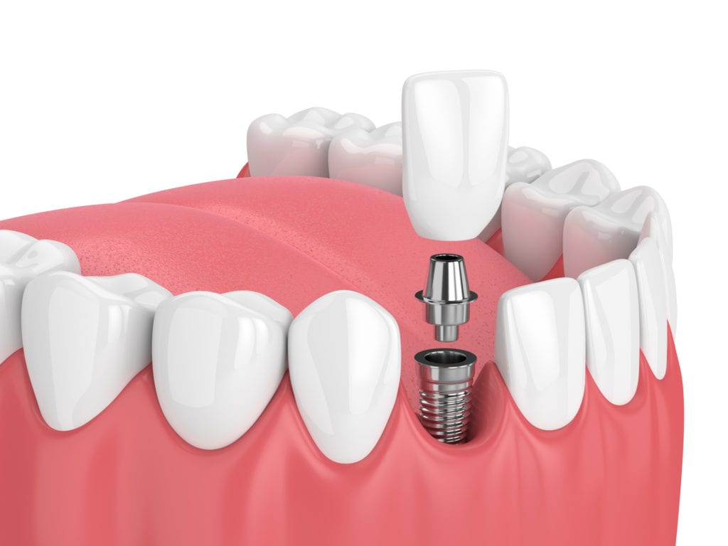 Dental Implant Questions in Middle River, Maryland